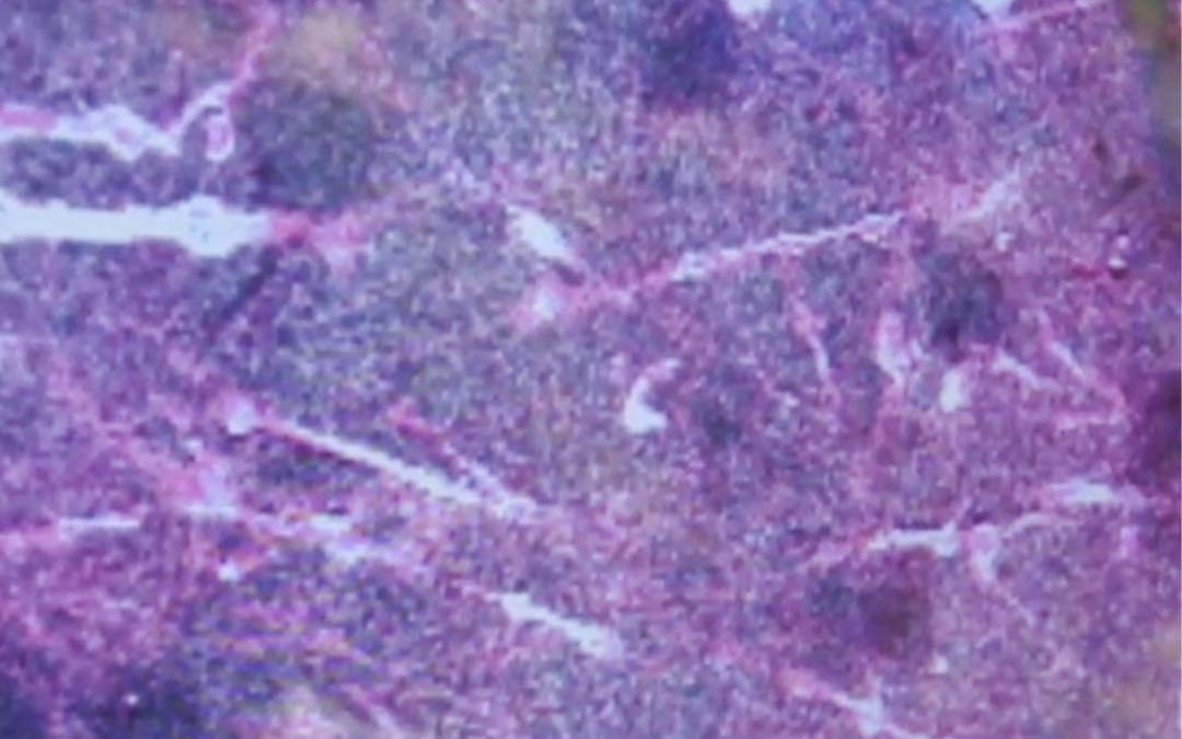 AI is Saving Lives by Spotting Cancer Surgeons Cannot See
