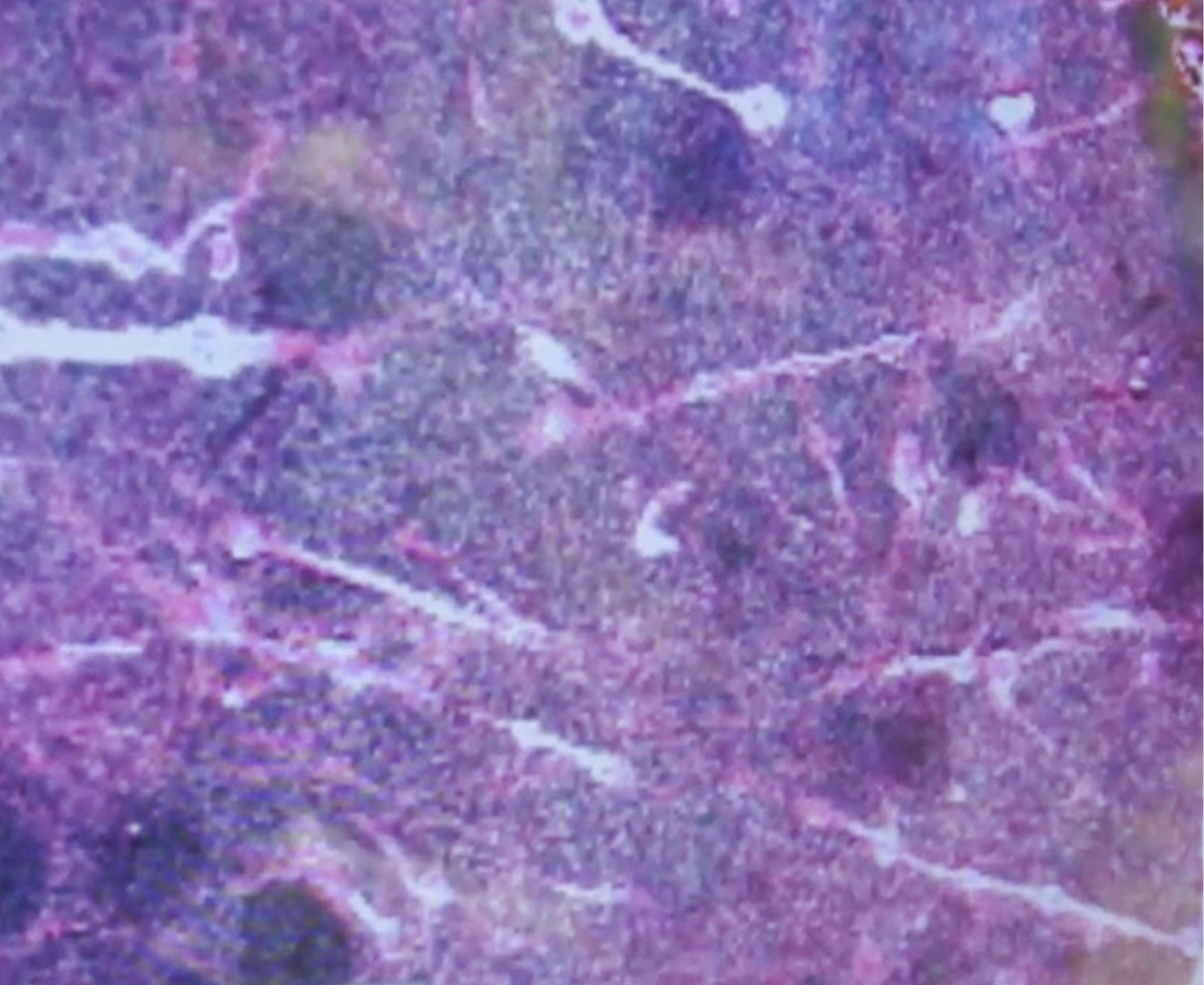 CT image of brain with tumor cells